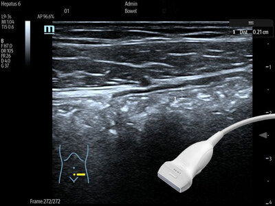 The Hepatus 6 Integrates ViTE with diagnostic ultrasound to support liver, spleen, and bowel assessment within a unified workflow.