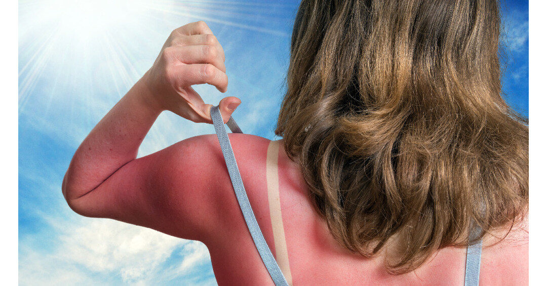 MedStar Health Survey Finds More Than Three-Quarters of Adults Don't Know Melanoma Can Become Life Threatening in Just Six Weeks