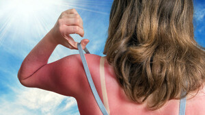 MedStar Health Survey Finds More Than Three-Quarters of Adults Don't Know Melanoma Can Become Life Threatening in Just Six Weeks