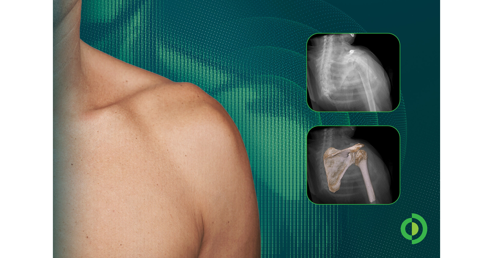 Advita Ortho Highlights New Research on AI-Generated Shoulder Digital Twins and Surgical Navigation at CAOS 2026