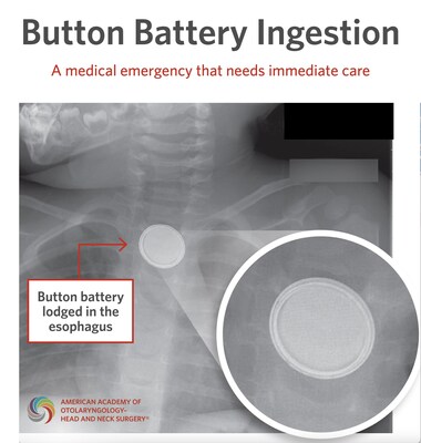 The AAO-HNS urges families to keep all coin-cell and button batteries out of children’s reach, secure battery compartments, and seek emergency care immediately if a battery ingestion is suspected.