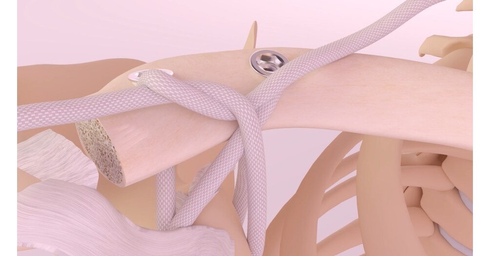 French orthopedic pioneer Movmedix enters the United States following FDA clearance of LARS® Technology