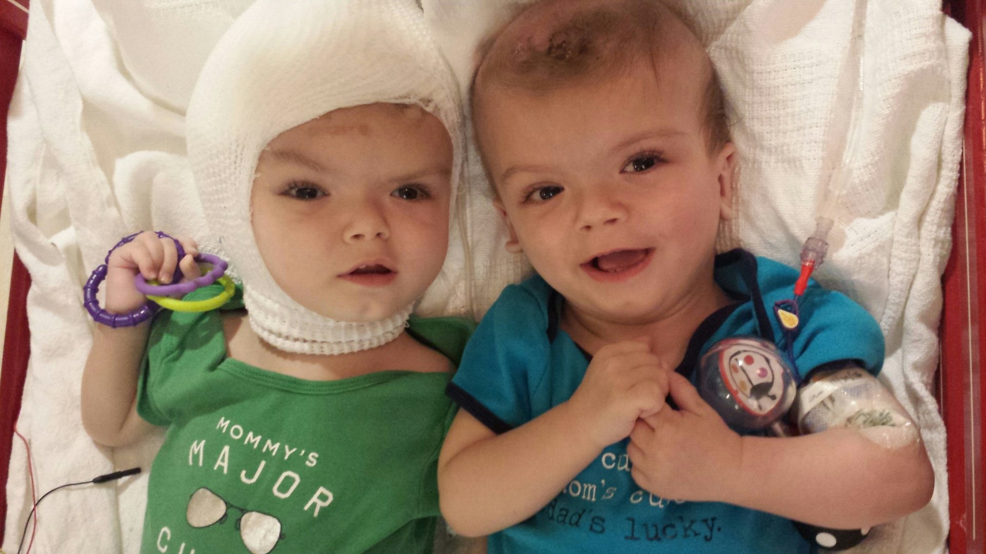 Separate But Together Formerly Conjoined Twins Jadon and Anias