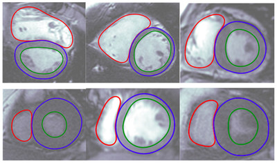 Unlike traditional medical imaging software, Arterys Cardio DLTM uses deep learning, a form of artificial intelligence, to automate time-consuming analyses and tasks that are performed manually by clinicians today. The physician can edit the automated contours if desired. These images show the Cardio DLTM generated contours of the insides and outsides of the ventricles of the heart. The software can process a scan in just 10 seconds, compared to manual contouring performed by clinicians.