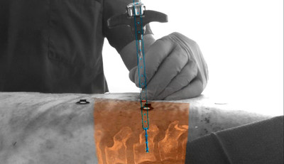 The new augmented-reality surgical navigation technology combines the external view captured by the cameras and the internal 3D view of the patient acquired by the X-ray system to construct a 3D augmented-reality view of the patient's external and internal anatomy. This real-time 3D view of the patient's spine in relation to the incision sites in the skin aims to improve procedure planning, surgical tool navigation and implant accuracy, as well as reducing procedure times.