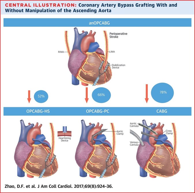 78% Stroke Reduction with Newer No-Touch Beating Heart Bypass Surgery ...