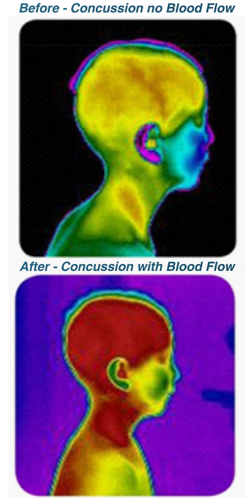 Thermography images of a concussion patient pre and post Cranial Suture Release Therapy (CSRT).
