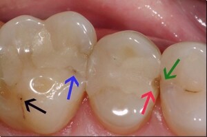 Bioactive materials offer a better alternative for dental fillings