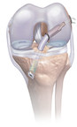 Mitek Sports Medicine Introduces Comprehensive Knee Arthroscopy Platform for ACL and Meniscal Repair