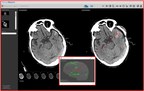 IBM Watson Health to Integrate MedyMatch Technology into Cognitive Imaging Offerings to Help Doctors Identify Head Trauma and Stroke