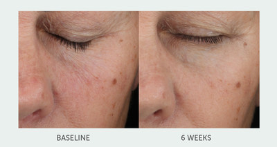 Topix Announces New Age Defying Retinol Treatment Serum. RetinolForte is clinically proven to show significant improvement in visible fine lines and wrinkles.