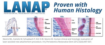 The LANAP protocol is clinically and histologically proven to reverse the destruction of gum disease, resulting in True Periodontal Regeneration.