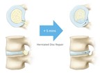 Texas Back Institute first in the US to provide herniated disc repair using Anchor Orthopedics' Technology