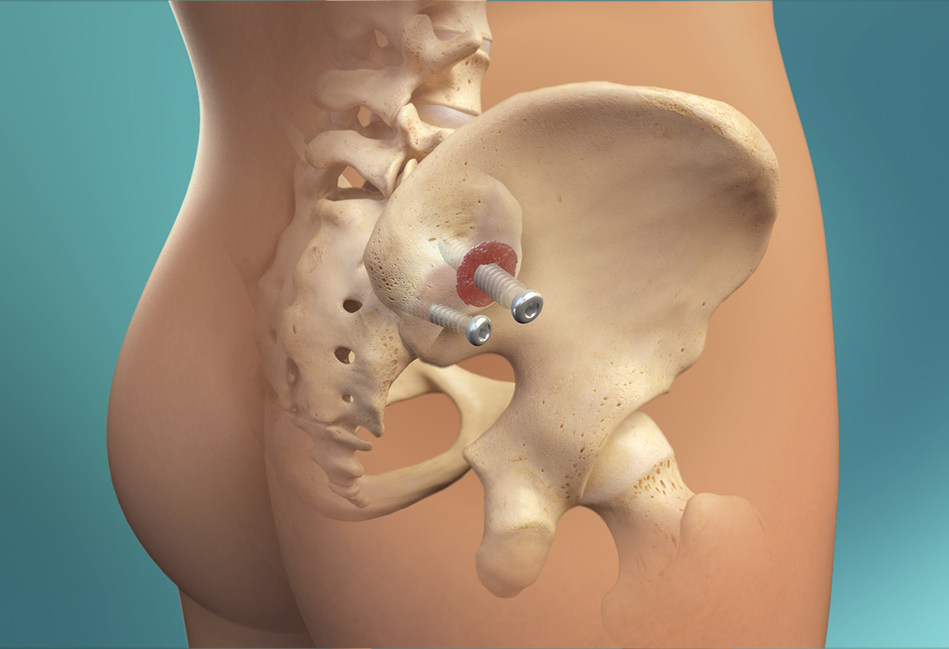 Surgery for sacroiliac joint pain