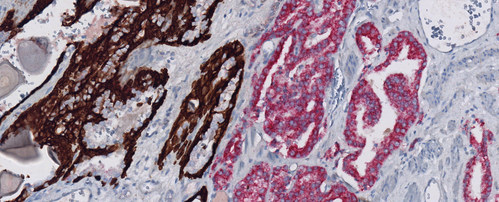 Prostate carcinoma dual stained with anti-p504s (SP116) Rabbit Monoclonal Primary Antibody in red, and VENTANA Basal Cell Cocktail (34ßE12+p63) in brown
