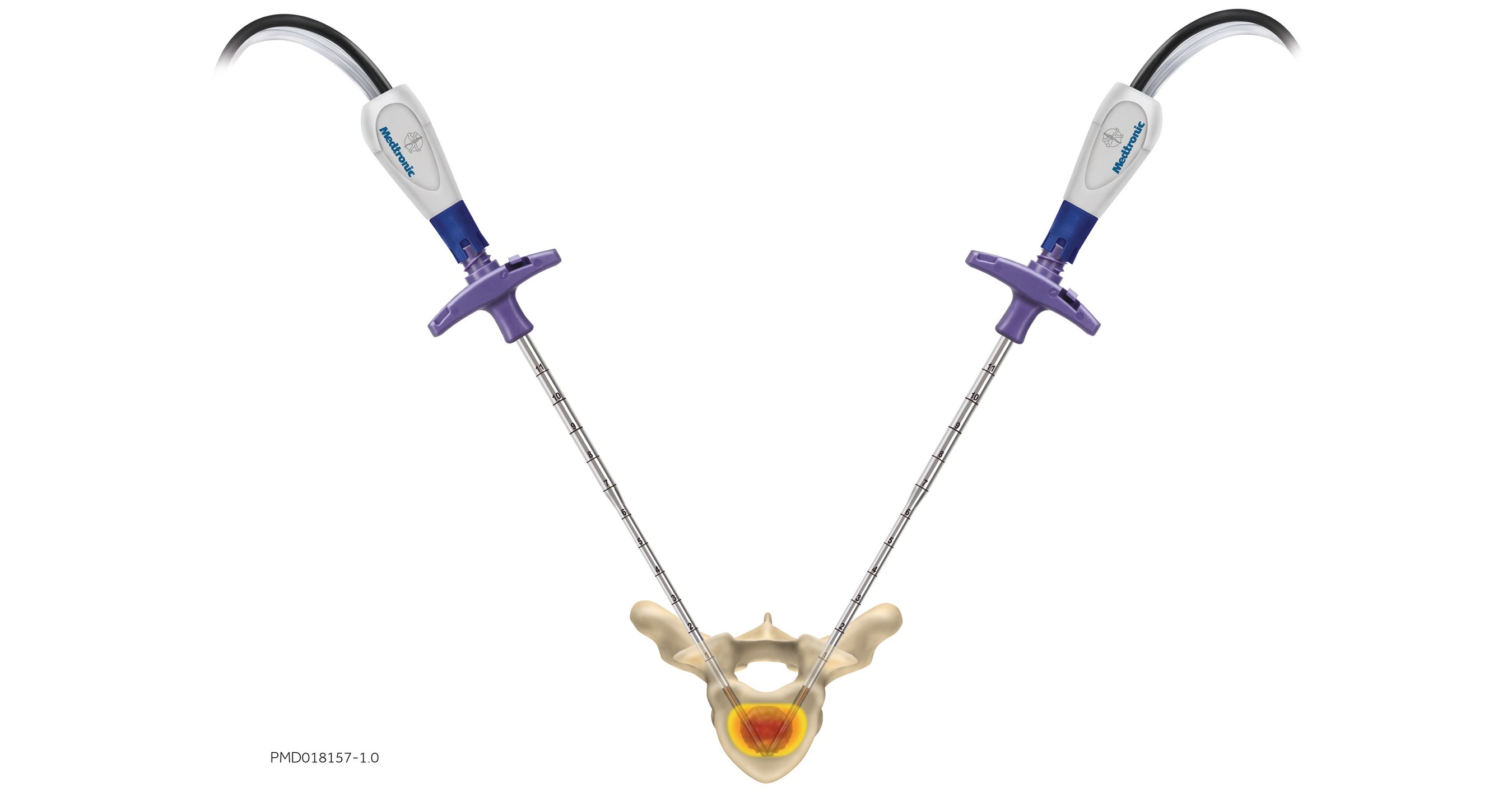 Medtronic Expands Pain Therapies Portfolio with the Launch of OsteoCool