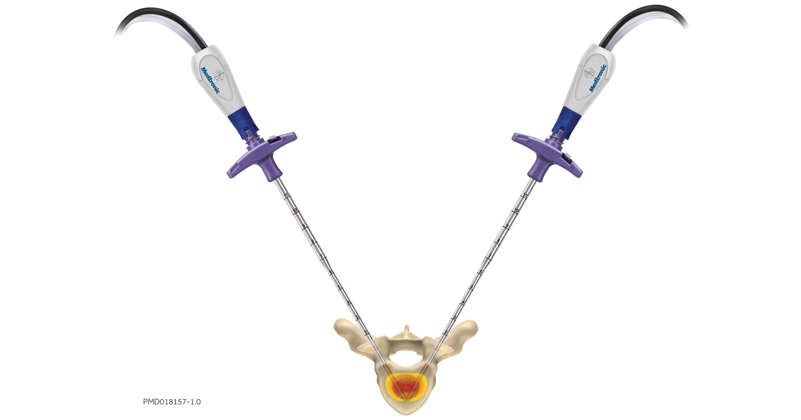 Medtronic élargit sa gamme de thérapies contre la douleur avec le