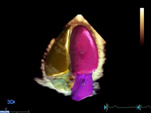 Multicenter study demonstrates 3D Echo image analysis with Philips' HeartModel(A.I.) is accurate and reproducible