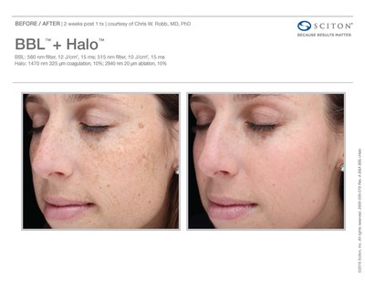 Before and after one Halo treatment