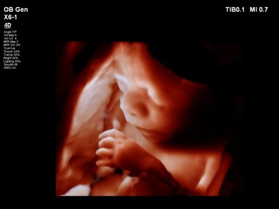 Philips TrueVue uses a virtual, moveable light source to allow clinicians the flexibility to illuminate the fetal face and deliver lifelike 3D ultrasound images.