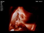 Philips new OB/GYN ultrasound innovations with anatomical intelligence provide lifelike 3D images to advance pregnancy care and support maternal-fetal bonding