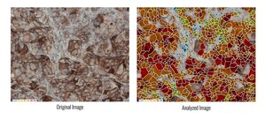 ASI's HiPath™ for Computer-Assisted PD-L1 Interpretation