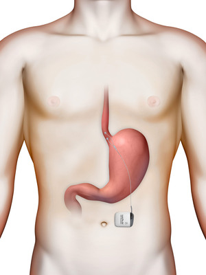 First patients at St. Joseph's Hospital and Medical Center implanted in EndoStim's LESS GERD clinical trial for gastroesophageal reflux disease (GERD)