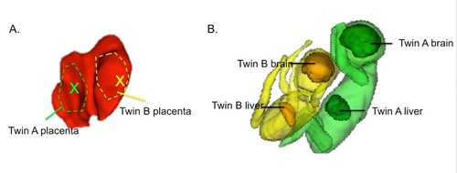 These images were reconstructed from the fetal MRI. The image at left shows the placenta partitioned into two sections, each supplying blood to one twin. At right, twin B, whose placenta delivered oxygen more slowly, is smaller and has a smaller liver and brain than twin A, whose placenta delivered oxygen more rapidly.