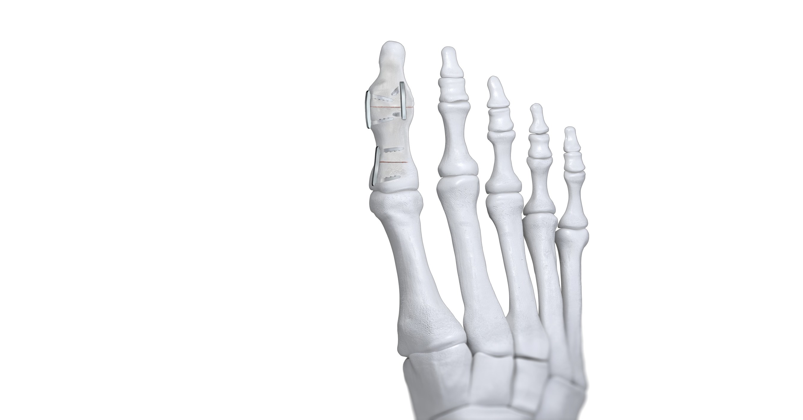 Paragon 28® announces launch of JAWS™ Nitinol Staple System to address