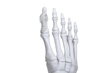 Paragon 28® announces launch of JAWS™ Nitinol Staple System to address fracture and osteotomy fixation of the foot