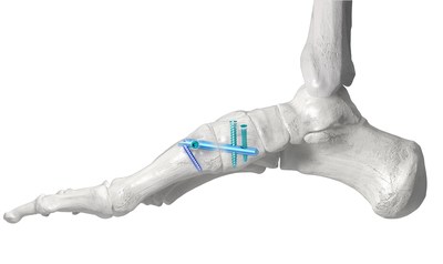 Paragon 28® launches the PHANTOM™ Lapidus Intramedullary Nail System, the first intramedullary nail option to correct hallux valgus at the 1st TMT joint