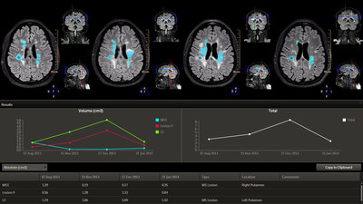 LoBI is an application to analyze brain images to support the evaluation of neurological disorders over time.