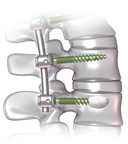 DePuy Synthes Launches New Fenestrated Screw Systems Designed for Enhanced Fixation in Patients with Advanced Stage Spinal Tumors