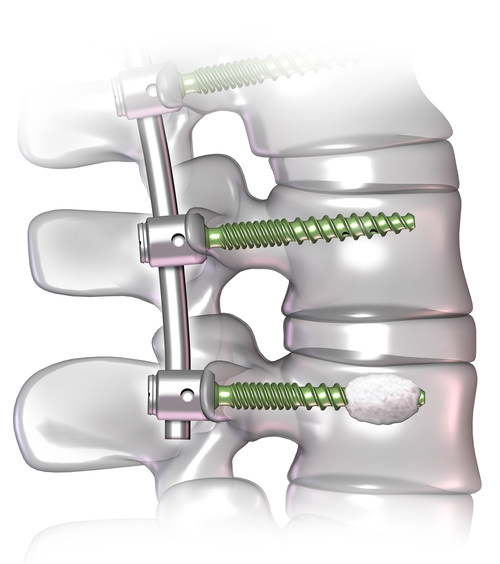 DePuy Synthes Launches New Fenestrated Screw Systems Designed for