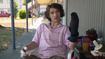 Kurtis Musewicz, 17, of Tacoma, Washington, lost four fingers on his left hand in a fireworks explosion on June 23, 2017.