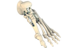 CrossRoads® Extremity Systems, LLC Announces Launch of the DynaFORCE™ Dynamic Compression Fixation System