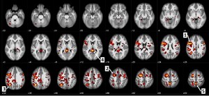 IBM and University of Alberta publish new data on machine learning algorithms to help predict schizophrenia