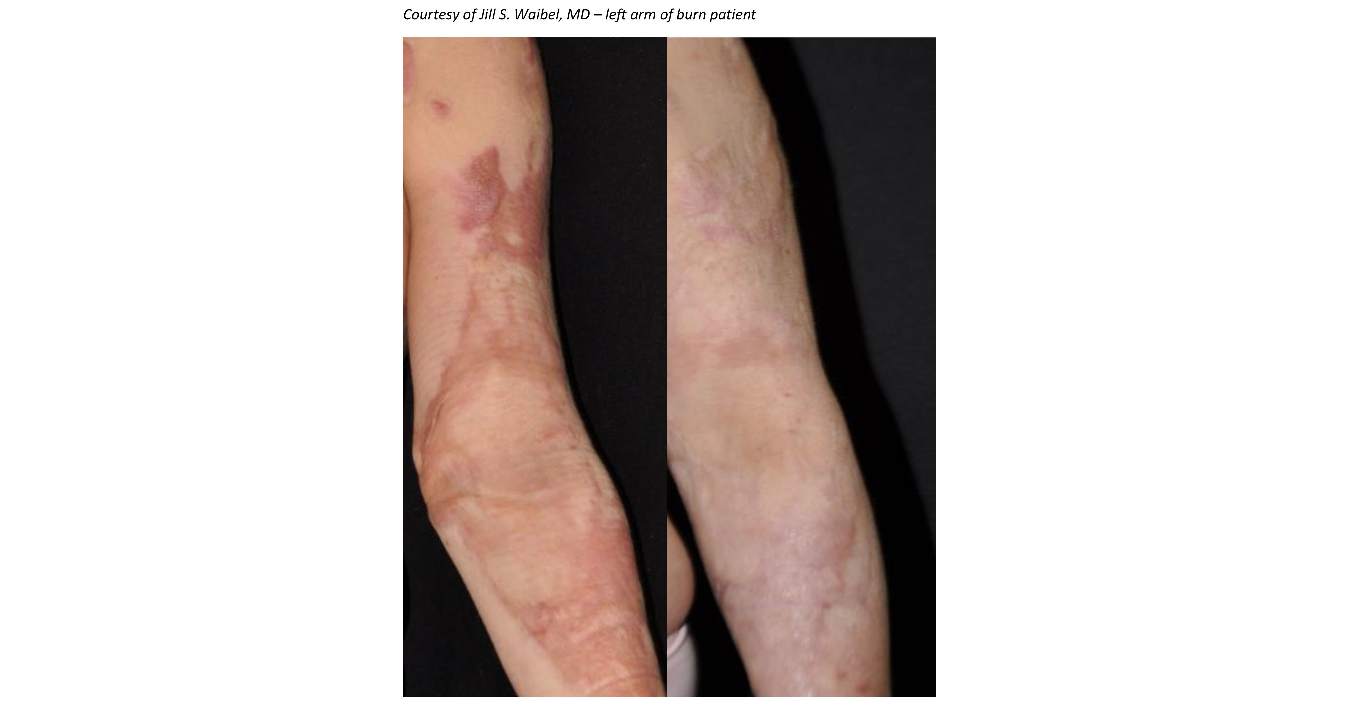 Early Treatment Is Revolutionizing Outcome Of Burn Scars