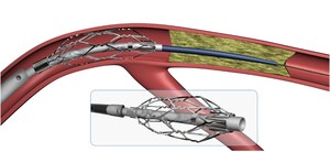 Roxwood Medical Announces Agreement with Abbott for Distribution of Products in U.S.