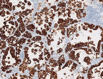 Non-small cell lung cancer tissue stained with the VENTANA anti-ALK (D5F3) Rabbit Monoclonal Primary Antibody and OptiView DAB Detection and Amplification