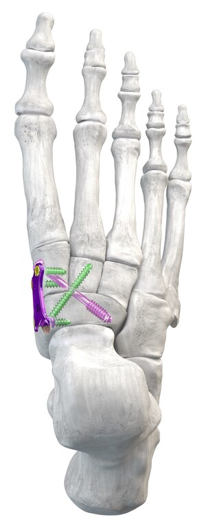 Paragon 28® Launches Plating and Guided Screw System to Address Naviculocuneiform Arthritis and Flatfoot- Gorilla® NC Fusion Plating System.