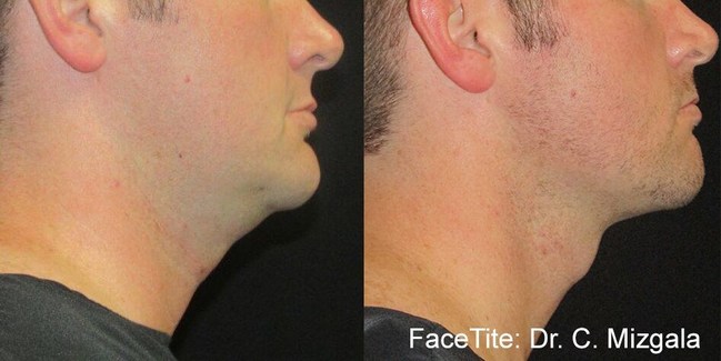 InMode Skin Tightening Technology is the Missing Link Providing Surgery Like Results Without 