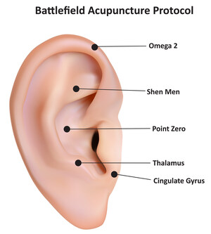 A New Pain Management Process for the Military: MPS Applied to Battlefield Acupuncture (BFA)