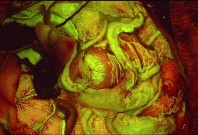 View of an Arteriovenous Malformation (AVM) viewed with FL560 fluorescence. Photo courtesy of Cleopatra Charalampaki, MD, PhD, Professor of Neurosurgery, Department of Neurosurgery, Cologne Medical Center, Germany.