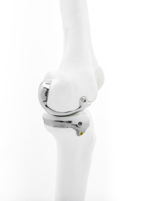 Bodycad’s Unicompartmental Knee System provides a truly personalized orthopaedic restoration designed to match the exact anatomical needs of a patient.