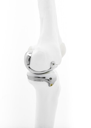 Bodycad Announces First Use of Its Unicompartmental Knee System in Patients