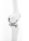 Bodycad annonce la première utilisation chez les patients d'un mécanisme unicompartimental pour le genou