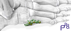 Paragon 28® launches 5th metatarsal fracture specific plating system, expanding the Baby Gorilla™ Mini Plating System offering