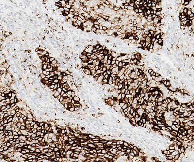 Positive non-small cell lung cancer (NSCLC) tissue stained with PD-L1 (SP142) assay