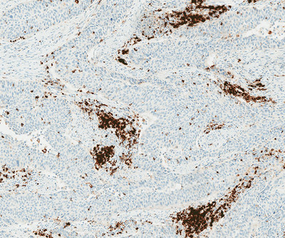 Positive urothelial carcinoma (UC) tissue stained with PD-L1 (SP142) assay
